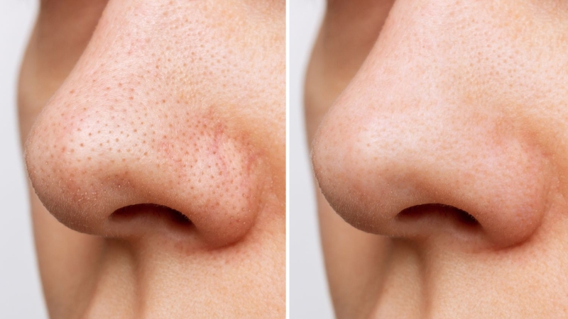 Blackheads can be the most frustrating type of clogged pores. Here, dermatologists share the best ways to get rid of blackheads, from at-home to in-office treatments.